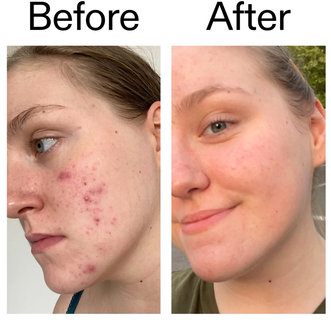 Winter Skincare Bundle(Glycolic Acid Serum with De-Puff Eye Roller)